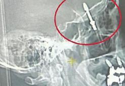 Diş implantı kafasına saplandı