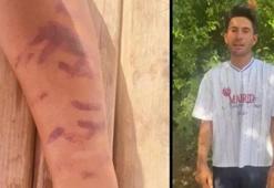Lazer epilasyon 23 yaşındaki adamın kabusu oldu! Ben yandım başkaları yanmasın diye isyan etti