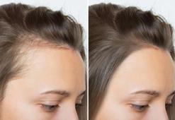 Saç dökülmesini önlemenin 3 basit yolu