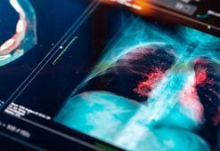 Her yıl binlerce kişinin ölmesine neden oluyor! Uzmanlar sessiz tehlike 'zatürre'ye karşı uyarıyor