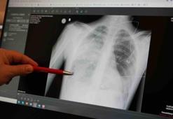 Uzmanı uyardı: "Zatürre ölümünüze neden olabilir"