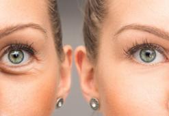 Göz kapağındaki fonksiyonel sorunlar ne zaman müdahale gerektirir?