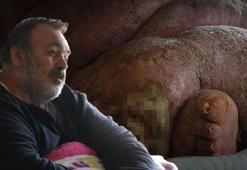 5 yıldır dört duvar arasında yaşayan 300 kiloluk fil hastasının tek hayali: Eşiyle el ele yürümek
