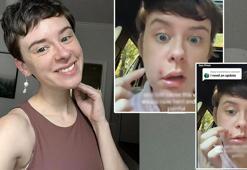 'Ölüm üçgeni'ndeki sivilceyi sıktı, yüzünün yarısı felç oldu! Genç kadın 6 hafta kabusu yaşadı