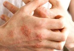 Egzama ve kuruluğa doğal retinol! Cildi canlandıran ürünün tek damlası yetiyor