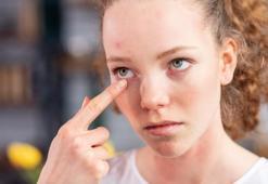 Kış gribi gözleri de vuruyor: Uzmanı uyardı