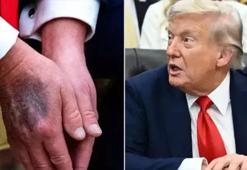 Sebebi ortaya çıktı! Trump elindeki morlukların neden oluştuğunu açıkladı