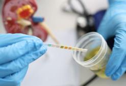 Koyu renkli idrar her zaman tehlikeli mi? Uzman isimden kritik açıklama