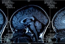 İnsan beyni 18'de değil 32 yaşında olgunlaşıyor! Bilimsel araştırmalarla kanıtlandı