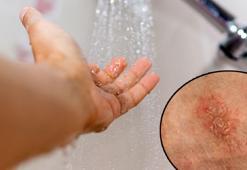 Banyo yaparken bu hataya sakın düşmeyin! Egzama hastaları için yıkım sebebi