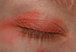 Gözleriniz sürekli kızarıyor mu? Sebebi sizi şaşırtabilir