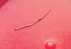 Bebeğin sırtından zımba teli çıktı