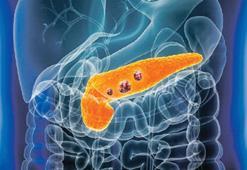 Pankreas kanserinde tedavi heyecanı