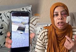 Yolda görünmeyen tehlike! Kapağı kırık rögara düştü: Yüzüne 14 dikiş atıldı