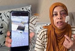 Gizli tehlike can yaktı: Kırık rögar kapağı yüzünden yaralandı