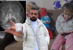 Doktorlar 'soba isi' dedi, ameliyatta çıkan şey şoke etti! 2 yıl burnunda onunla yaşamış