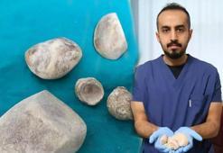 Doktorları bile şaşırttı! Mesane ve idrar kanalından yarım kilogram ağırlığında 6 taş çıktı