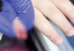 Yürüyen merdiven parmağını kopardı