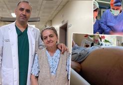 Kabızlık şişkinliği sandı, karnından tam 22 kilo tümör çıktı! Ameliyattan önce 79 kilo olan kadın 57'ye kadar düştü