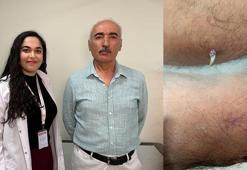 Dirseğinde küçük bir yara sandı… Gerçek bambaşka çıktı: 'Geçmeyen yaraları ihmal etmeyin'