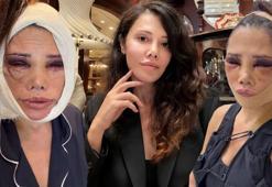 Didem Ceran yüz gerdirme ameliyatının 12. gününden paylaştı! 'Yarı felç var, ağzım yamuk'