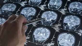 Yapay zeka epilepside çığır açtı! Çocukların beynindeki gizli lezyonları tespit etti