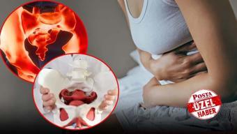 Kasık ve bel ağrısını sakın geçiştirmeyin! Başka rahatsızlıklarla karıştığı için tanısı gecikiyor, şiddetli regl ağrılarının sebebi olabilir!