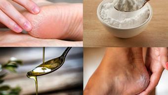 Topuk çatlaklarını onaran doğal formül! 2 malzemeyle hazırlanıyor