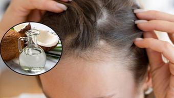 Tepe bölgesindeki saç dökülmesini durduruyor! 3 malzemeyle saç köklerini canlandırmak mümkün