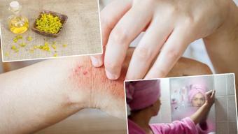 Kışın egzamanın coşmasına neden olan hata! Çare evde hazırlanan o karışımdaymış