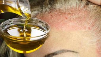 Egzama ve kaşıntının kökünü kazıyor! 1 damlası yetiyor ama o detaya dikkat edilmeli