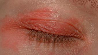 Gözleriniz sürekli kızarıyor mu? Sebebi sizi şaşırtabilir