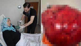 Kilo aldı sandılar karnından çıkan şok etti! Tam 10.5 kilo... Fransa'da yaşayan kadın şifayı Samsun'da buldu!