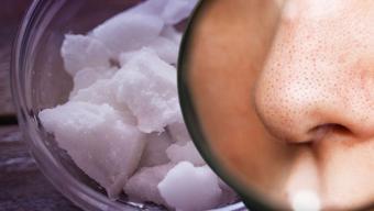 Siyah noktaları vakum gibi çeken ikili! Cildi derinlemesine arındırıyor