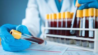 Kanserin en sevdiği kan grubu ortaya çıktı: Bu gruba sahipseniz hastalık daha agresif seyrediyor