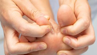 Ayaklardaki mantar ve nasıra veda ettiriyor! Evde hazırlayabileceğiniz en güçlü doğal karışım