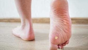 Nasır ve mantarın kökünü kurutuyor! Sadece 2 malzemeyle hazırlanan karışım, ayakları pamuk gibi yapıyor