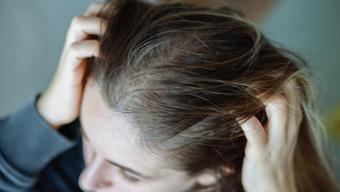 Saç dibindeki egzama ve mantarın kökünü kazıyor! 5 dakika bekletmek yetiyor