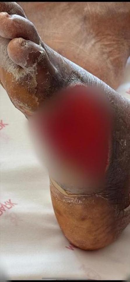 Kopardığı nasır hayatını kararttı Ayağı kesilme noktasına geldi