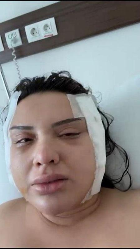 ‘Badem göz’ ameliyatı hayatını kararttı Genç kadının estetik kabusu