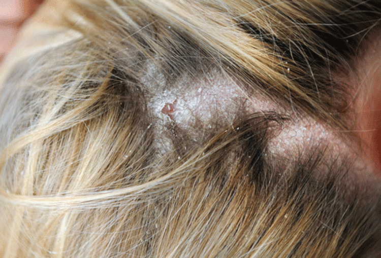 Egzamayı tetikleyen besinler