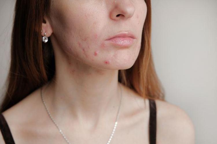 SİVİLCELERİ KURUTAN DOĞAL MASKE
