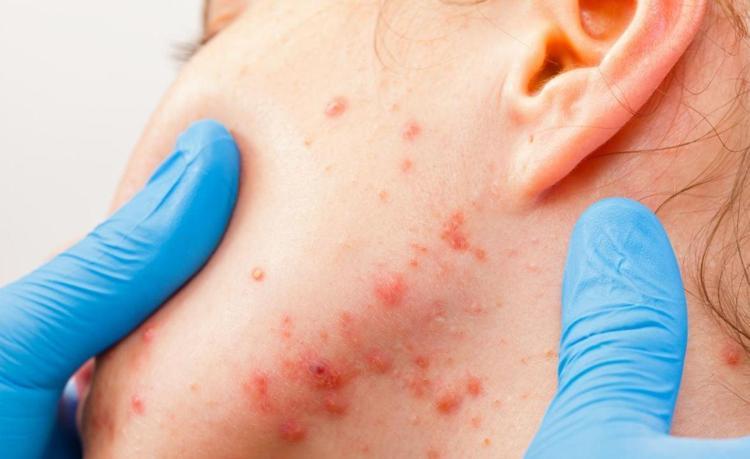 SİVİLCE İÇİN BAL MASKESİ