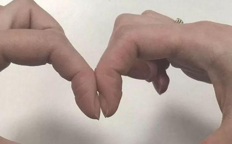Akciğer kanserini teşhis eden parmak testi: Elmas testi nedir, nasıl yapılır