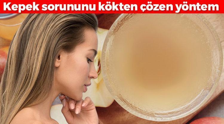 Saçta kepek, egzama bırakmıyor Tek bir damlası bile yetiyor: Elma sirkesiyle karıştırın