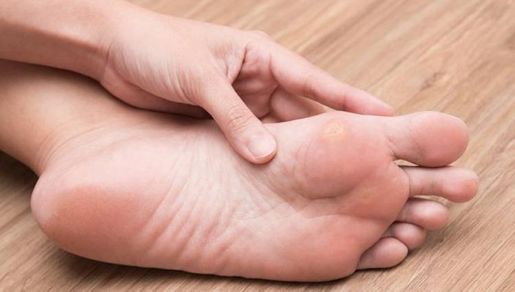 1 gecede nasıra veda Kabuğunu kullanarak evde nasırdan kurtulmak çok kolay