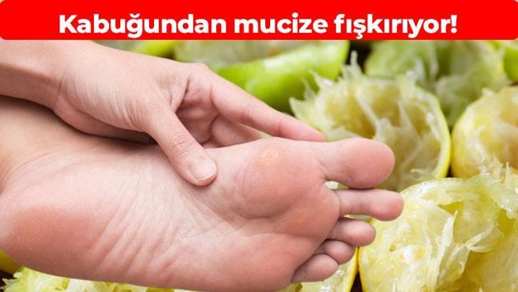 1 gecede nasıra veda Kabuğunu kullanarak evde nasırdan kurtulmak çok kolay