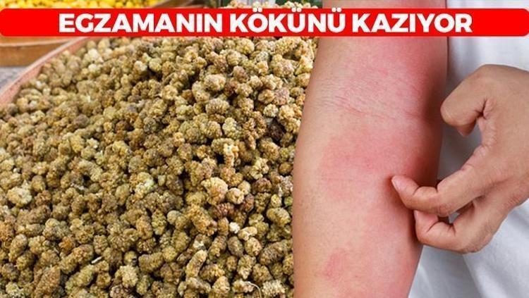 Pul pul dökülmeyi anında bitiriyor Egzamadan eser kalmıyor