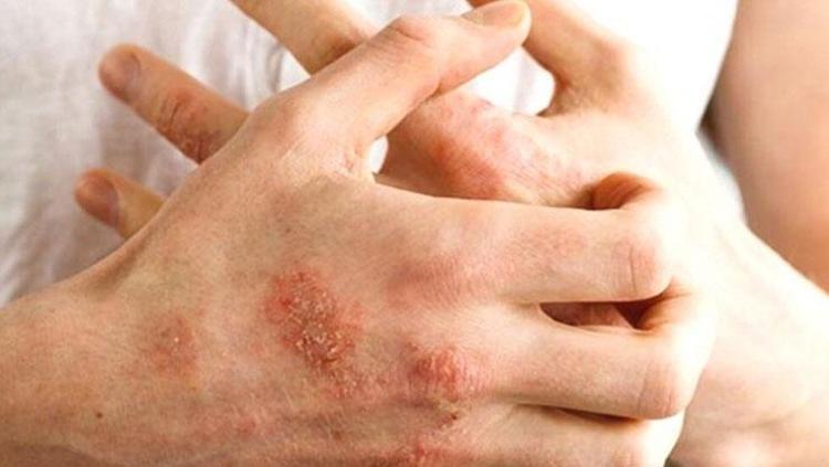 Her gün bayıla bayıla yiyoruz ama o hastalığı tetikliyor Tüketildiği anda belirtileri alevlendiriyor: Soframızın vazgeçilmezi ama sağlık için büyük risk