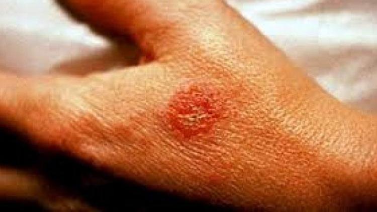 EGZAMADAN KURTULMANIN YOLU SAĞLIKLI BESLENMEDEN GEÇİYOR